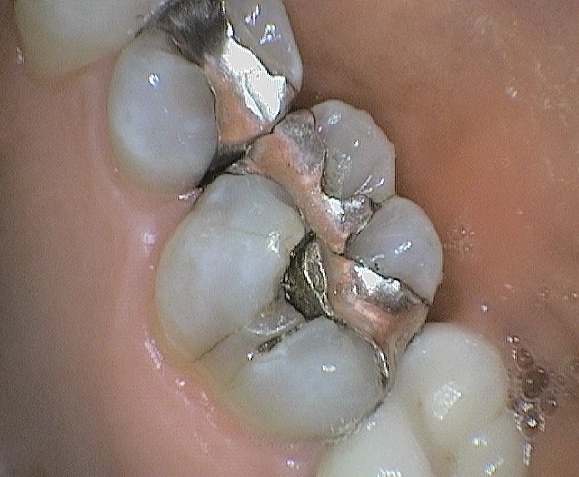 Tooth Colored Fillings Timbercrest Dental Center, Appleton WI