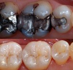 large amalgam fillings replaced with porcelain crowns