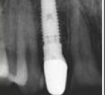 X-ray of Implant post