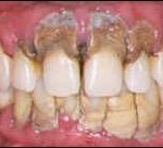 gum disease gingivitis