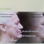 Photo 1 - Thinning of lips and pointing of chin due to multiple lost teeth.