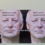 Photo 2 - Lines become more visible, jowls appear and mouth loses shape with multiple tooth loss.