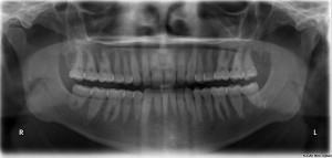 Our tech sources inform us that dental X-Rays will be part of the iPhone 7 Camera. Image Credit to Wikimedia Commons